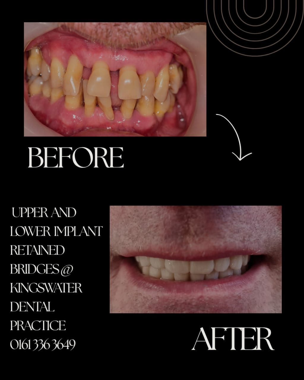 Dental Implants