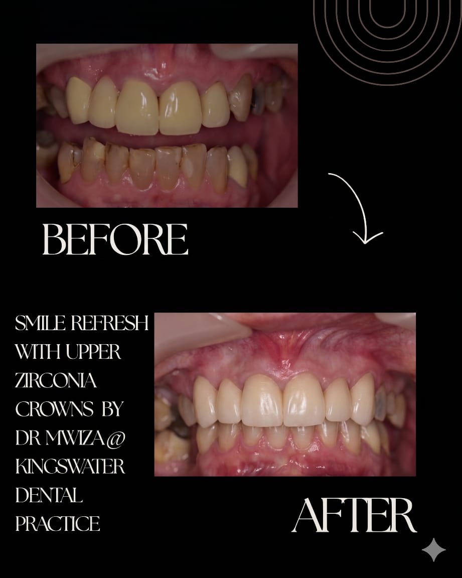 Composite Bonding Manchester